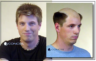 Integrated Hair Solutions of Rochester Hair Replacement Specialists