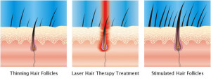 foliclesgrowinglasertreatment